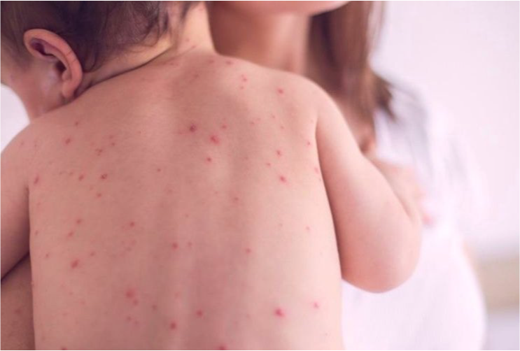 Улаанбурхан өвчнөөр 26 хүн эмнэлэгт хэвтэн эмчлүүлж байна